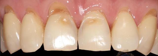 Клиновидный дефект зуба – поражение клиновидной формы в области шейки зуба