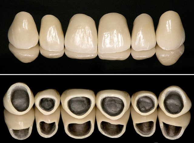 Металлокерамические коронки - попробуйте отличить от натуральных зубов