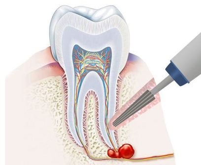 Киста - доброкачественное образование в области верхушки корня зуба