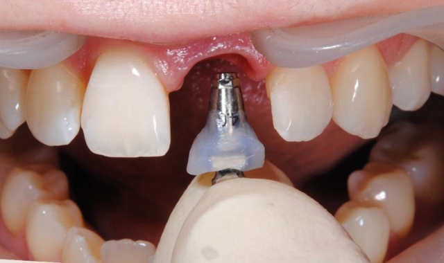 При одномоментной имплантации имплант вживляется в десну сразу после удаления невосстанавливаемого зуба