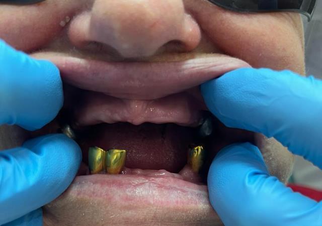 До протезирования: полное отсутствие зубов верхней челюсти и частичное отсутствие зубов нижней челюсти