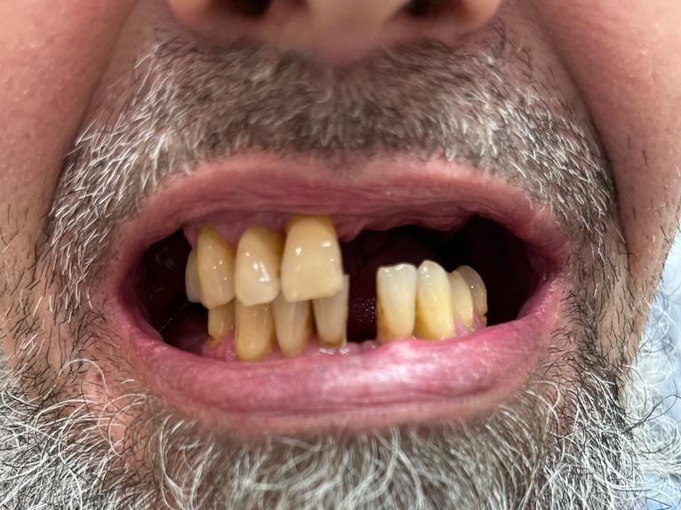 Частичное отсутствие зубов на верхней и нижней челюстях