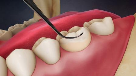 Это процедуры удаления зубного камня и налета