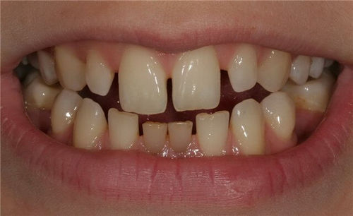 Тремы и диастемы - промежутки между зубами