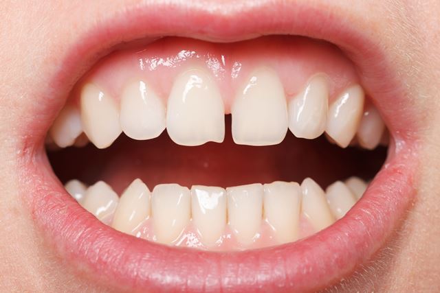 Диастема - сильно выраженная щель между зубами