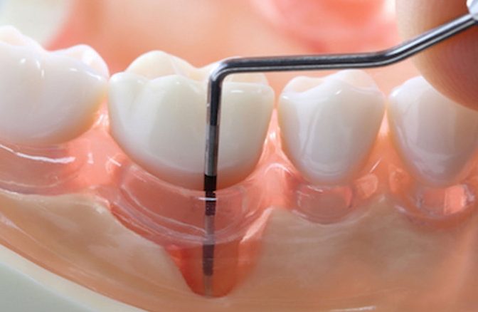 Десневой карман - это пространство между десной и зубом, вызванное воспалением пародонта и зубными отложениями.