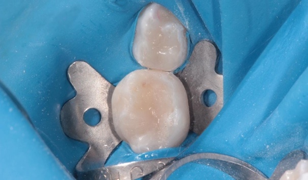 Для пломбирования молочных зубов используются предельно нейтральные компоненты