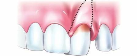 Вывих зуба – травматическое повреждение зуба, смещение его и повреждение периодонта