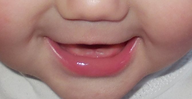 Позднее прорезание зубов у ребенка - одна из причин перикоронита