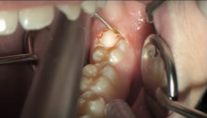 Удаление капюшона зуба мудрости - частая операция при перикороните